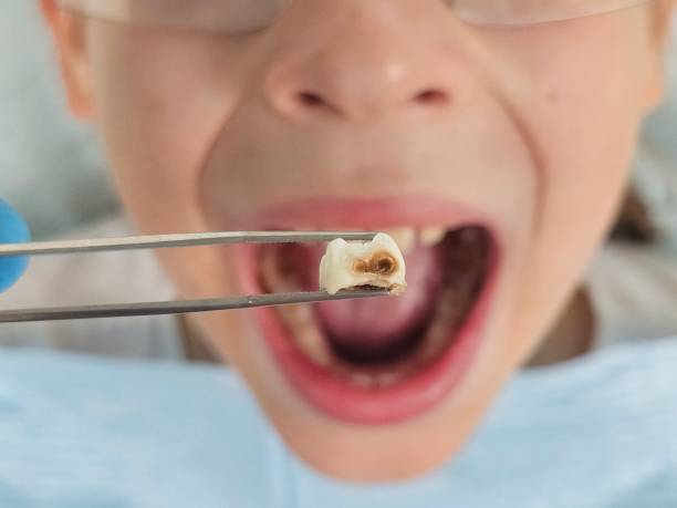 Best Emergency Dental Care for Broken or Chipped Teeth in Holiday Island, AR